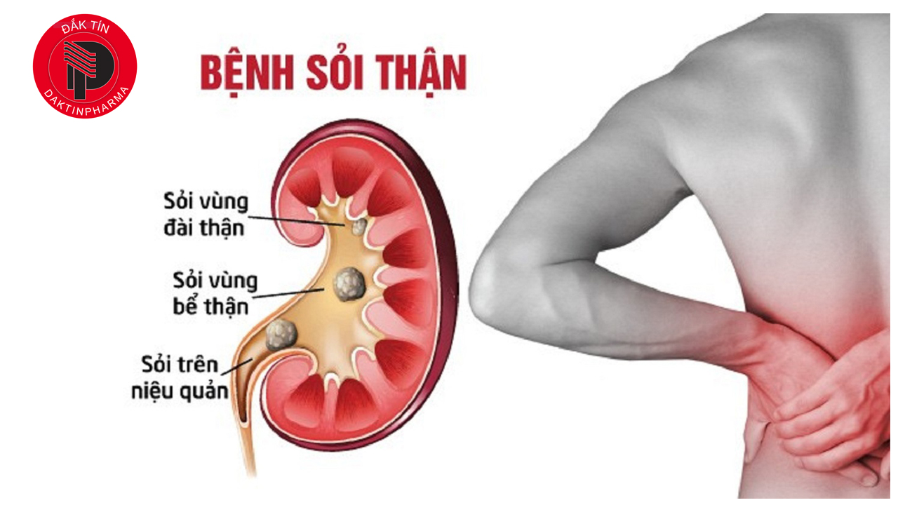 Sỏi thận: Nguyên nhân, Dấu hiệu và Cách điều trị